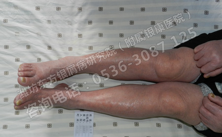 暮春时节要怎么样防止银屑病再次发作