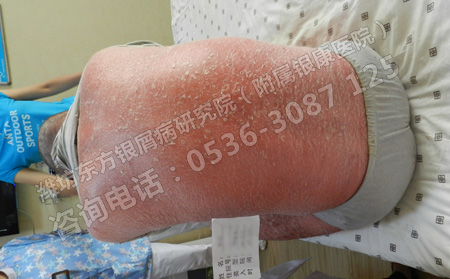 银屑病患者需要禁忌的三个方面
