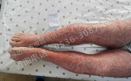 女性得了银屑病会遗传给宝宝吗
