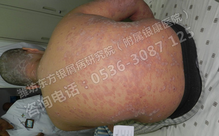 夏季来临老年银屑病患者消化不良怎么办