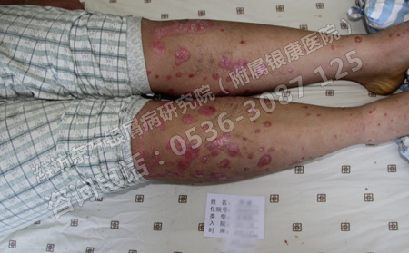 怎样预防寻常型银屑病病情加重