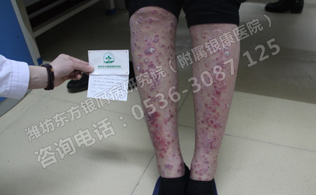得了银屑病对患者心理造成哪些危害