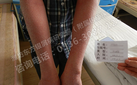 怎样帮助老年人治疗银屑病