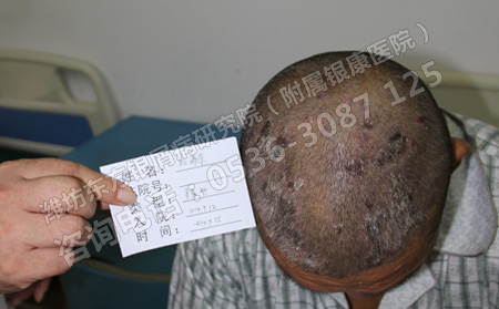 潍坊银屑病医院预防银屑病的四大原则