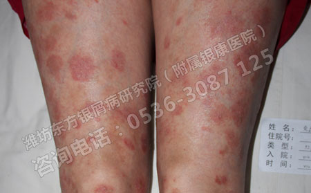 银屑病治疗的四大要点