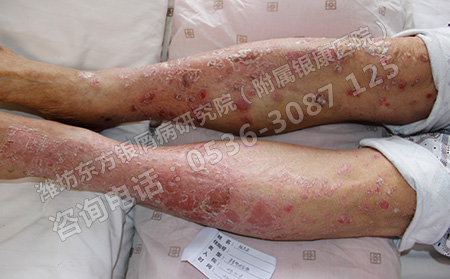 银屑病治疗禁忌你了解吗
