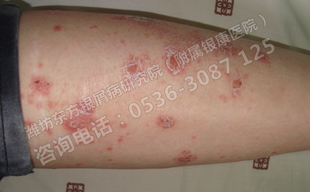 夏季有没有什么可以方法可以预防银屑病的出现