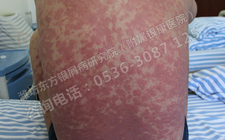夏季到来银屑病患者的日常护理方法
