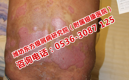 潍坊哪家医院治疗牛皮癣效果可以