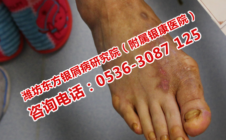 夏天出现女靴牛皮癣的原因是什么呢