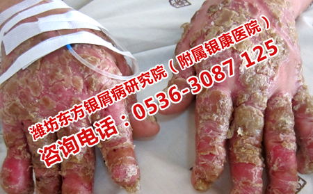关节型牛皮癣在夏天如何护理呢