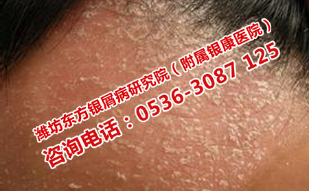 潍坊牛皮癣医院治疗需要多少钱呢