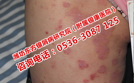 得了牛皮癣去哪里治疗呢