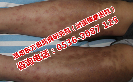 其他方治疗牛皮癣有效吗