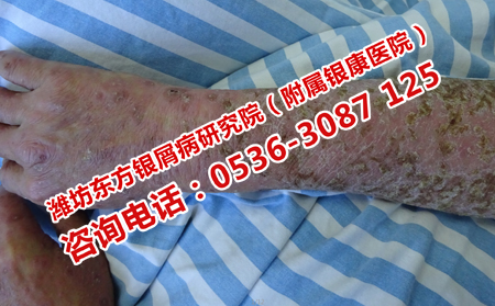 牛皮癣患者日常应该注意什么事情