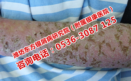 得了牛皮癣应该去哪儿治疗