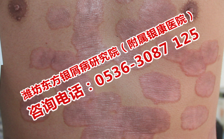 得了牛皮癣的后果很严重吗