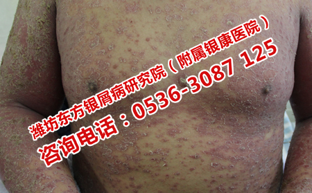 得了牛皮癣应该去哪儿治疗