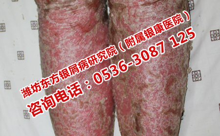 牛皮癣患者在夏季应该如何饮食