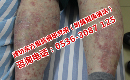 夏季牛皮癣患者洗澡有什么讲