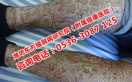老年人得了牛皮癣怎么办