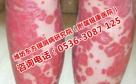 牛皮癣是不是血液疾病