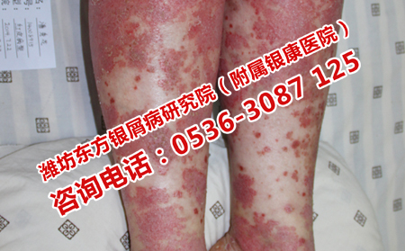 哪些因素会引起牛皮癣的病发