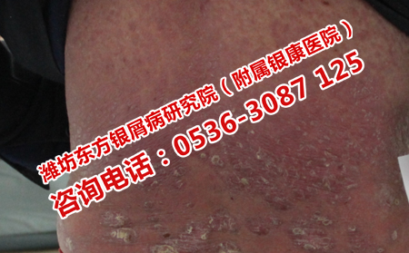 牛皮癣患者在日常吃点什么比较可以