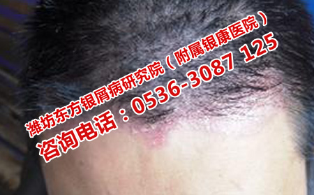 头部牛皮癣会不会导致掉头发