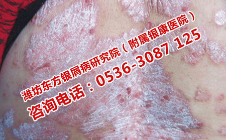 得了牛皮癣患者应该怎样护理