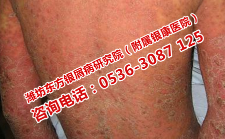 银屑病的实质危害