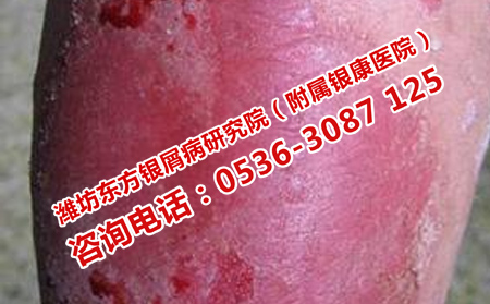 如何正确使用外用药物治疗牛皮癣