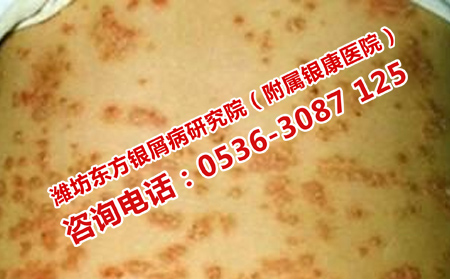 什么方法能够预防牛皮癣