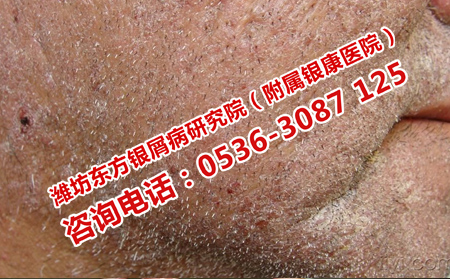 牛皮癣皮肤不同季节的护理