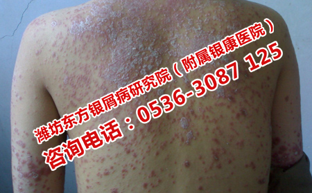 牛皮癣要怎样进行对症治疗