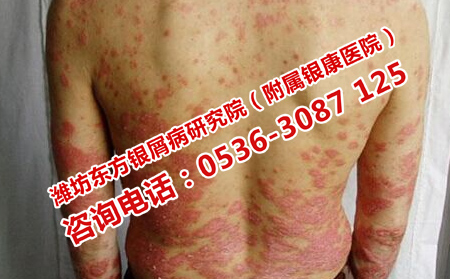 牛皮癣如何护理会比较可以
