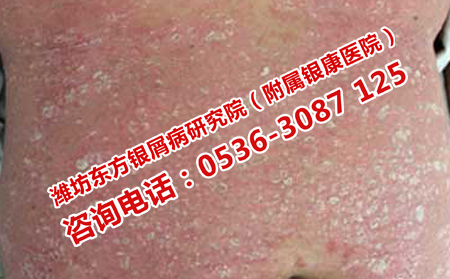 牛皮癣临床护理的难点