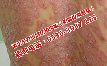 初期牛皮癣要怎样恢复呢