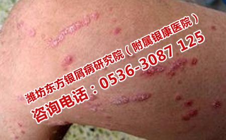 哪些习惯会诱发牛皮癣
