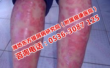 红皮型银屑病的严重危害有哪些