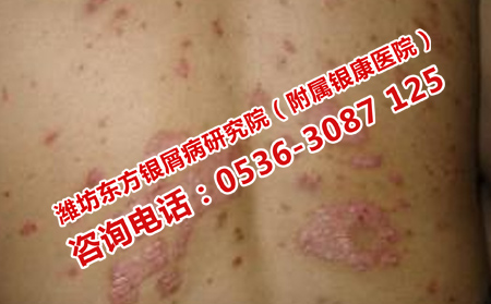 怎样护理可以稳定牛皮癣病情