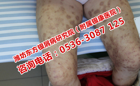 银屑病治疗过程中的禁忌
