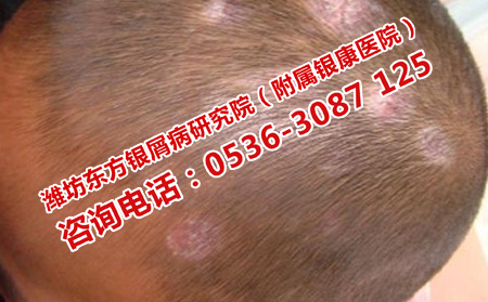银屑病是存在遗传几率的