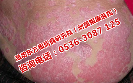 长银屑病的原因