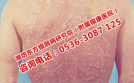 怎样防止银屑病的传染呢