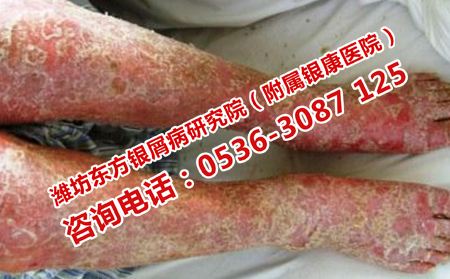 掌跖脓疱病的症状是什么