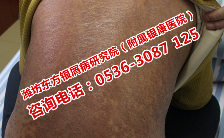 更可以的银屑病专科医院