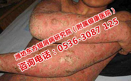 银屑病的严重危害