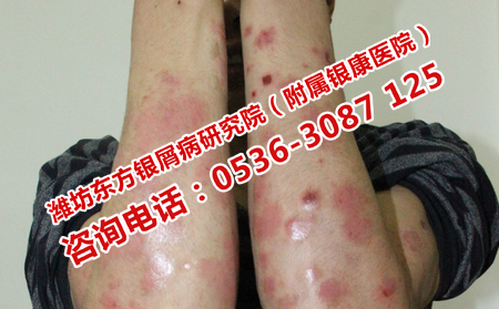 治疗银屑病期间如何护理