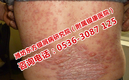 怎么治银屑病效果可以